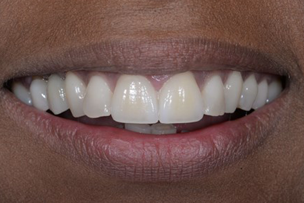 After Smile Makeover