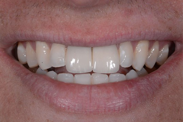 After Zoom Whitening