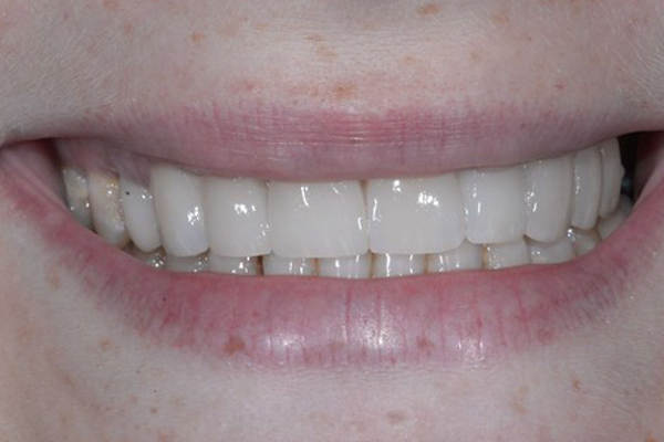 After Smile Makeover