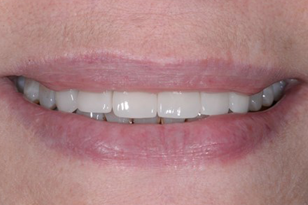 After Smile Makeover