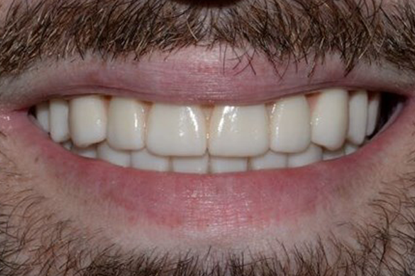 After Smile Makeover