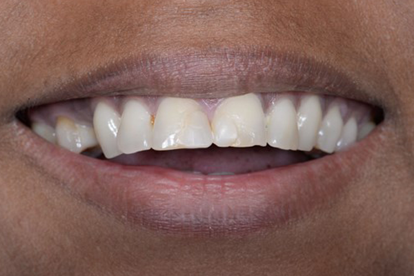 Before Smile Makeover