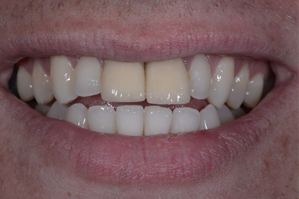 Before Zoom Whitening
