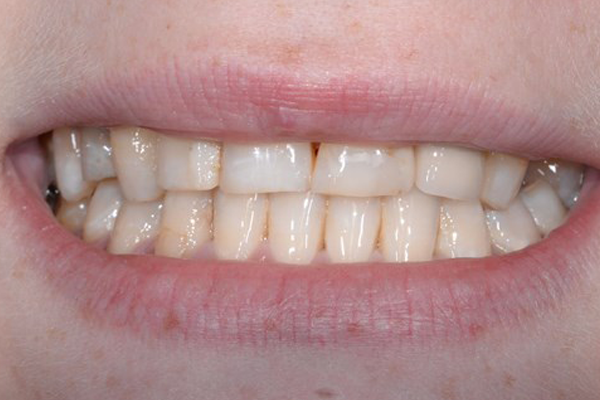 Before Smile Makeover