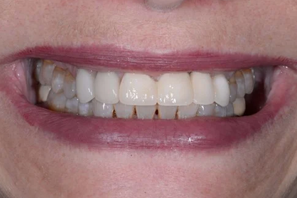 Before Smile Makeover