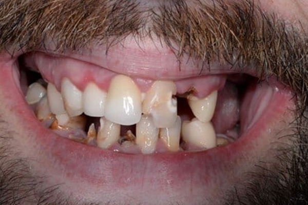 Before Smile Makeover