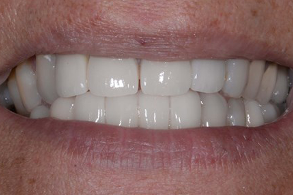 Smile Make Over After Case A Dr. Angela Ferrari