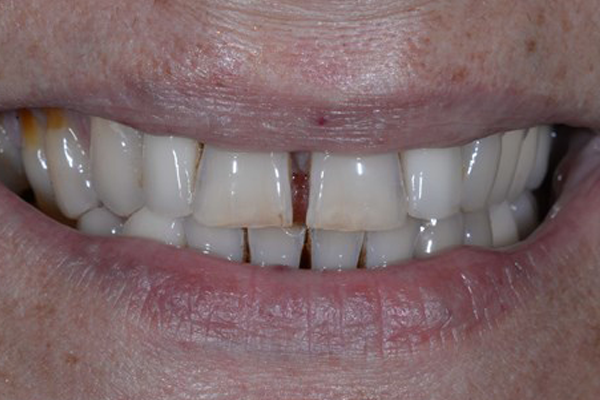 Smile Make Over Before Case A Dr. Angela Ferrari