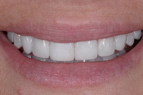 Zoom Whitening After Case F Dr. Angela Ferrari