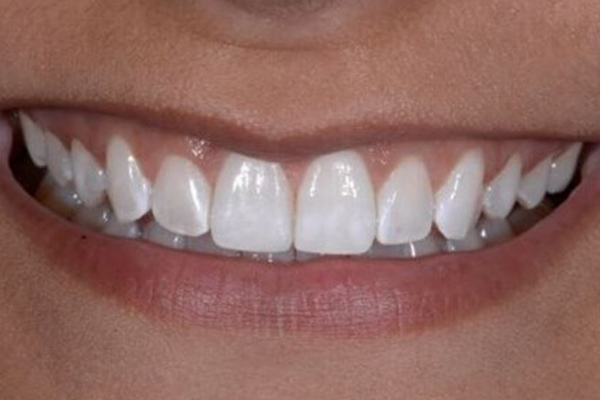 Zoom Whitening After Case I Dr. Angela Ferrari