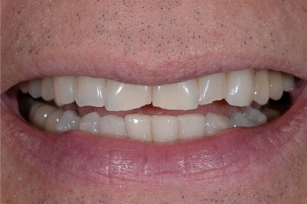 Zoom Whitening After case A Dr. Angela Ferrari