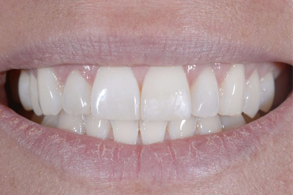Zoom Whitening After Case D Dr. Angela Ferrari