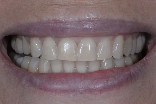 Zoom Whitening After Case E Dr. Angela Ferrari