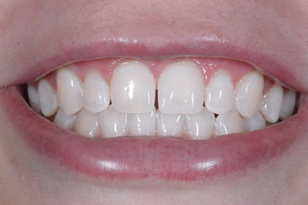 Zoom Whitening After Case F Dr. Angela Ferrari