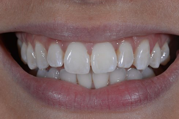 Zoom Whitening After Case H Dr. Angela Ferrari