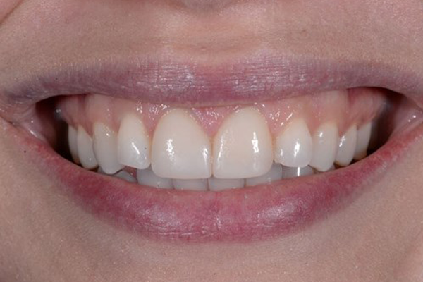 Zoom Whitening After Case J Dr. Angela Ferrari