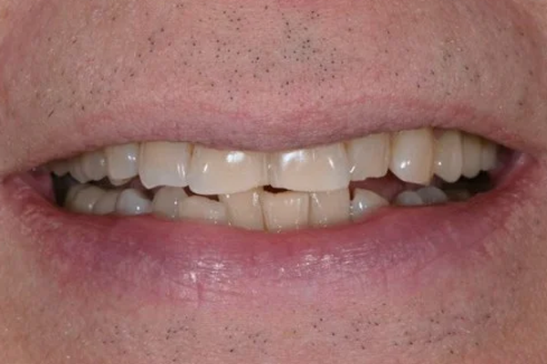 Zoom Whitening Before Case A Dr. Angela Ferrari