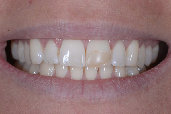 Zoom Whitening Before Case D Dr. Angela Ferrari