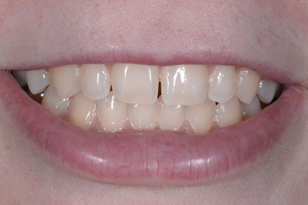 Zoom Whitening Case F Dr. Angela Ferrari