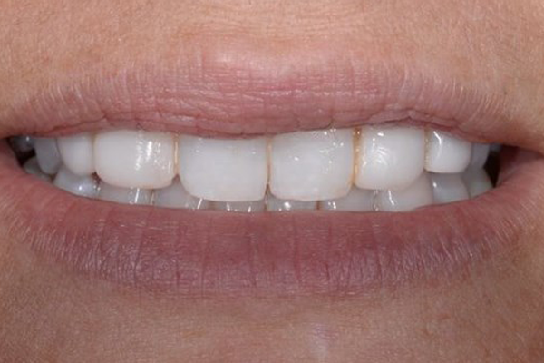 Before Zoom Whitening Case G