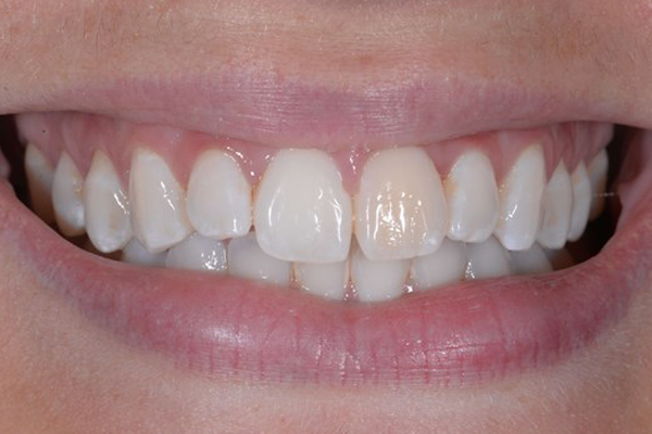 Zoom Whitening Before Case H Dr. Angela Ferrari