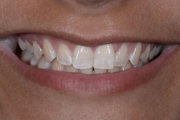 Zoom Whitening Before Case I Dr. Angela Ferrari