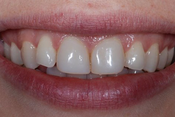 Zoom Whitening Before Case J Dr. Angela Ferrari