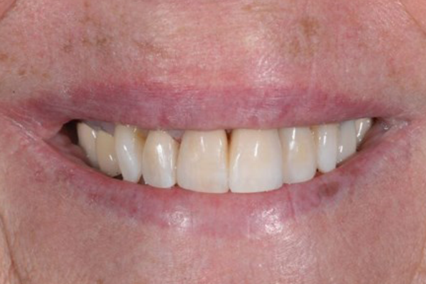 After Case A Cosmetic Bonding Case - Dr. Daniel Aldieri