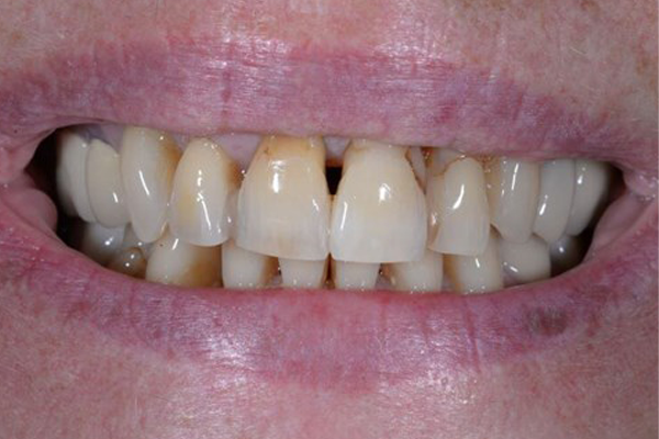 Before Case A - Cosmetic Bonding - Dr. Daniel Aldieri
