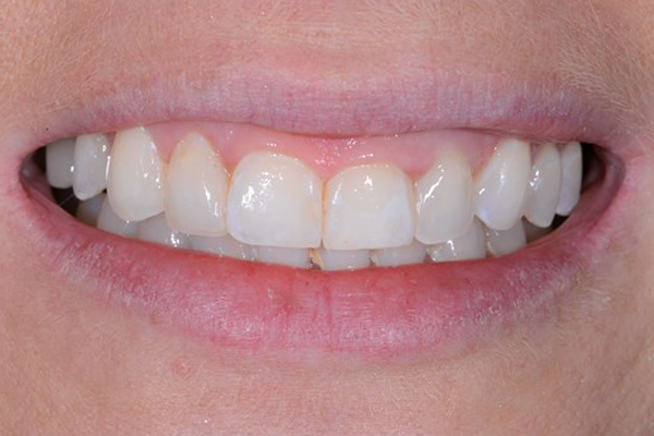 After Case B - Cosmetic Bonding Case - Dr. Daniel Aldieri