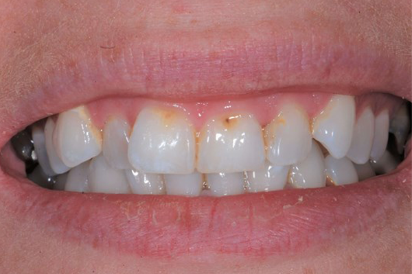 Before Case B - Cosmetic Bonding - Dr. Daniel Aldieri