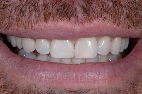 After Case C - Cosmetic Bonding - Dr. Daniel Aldieri