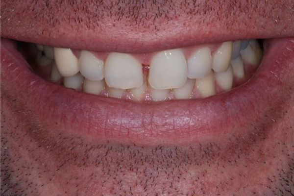 Before Case C - Cosmetic Bonding - Dr. Daniel Aldieri
