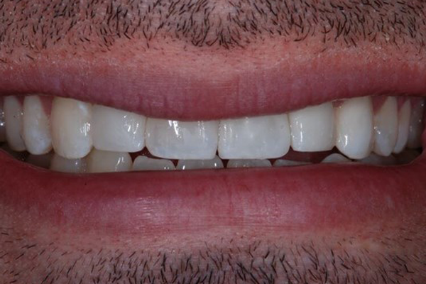 After Case D - Cosmetic Bonding - Dr. Daniel Aldieri