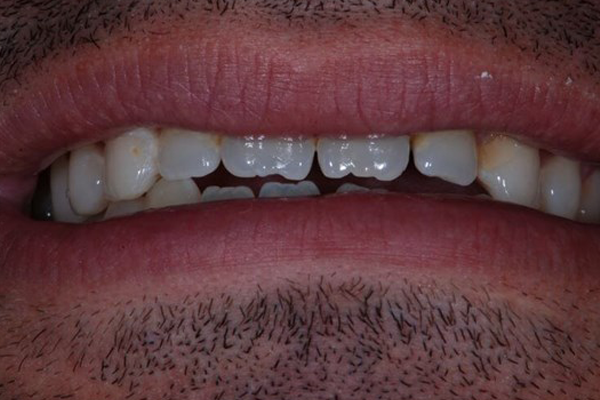 Before Case D - Cosmetic Bonding - Dr. Daniel Aldieri
