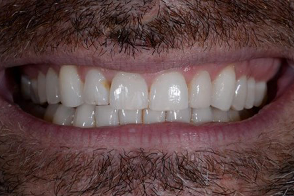 After Case E - Cosmetic Bonding - Dr. Daniel Aldieri