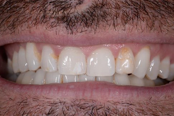 Before Case E - Cosmetic Bonding - Dr. Daniel Aldieri