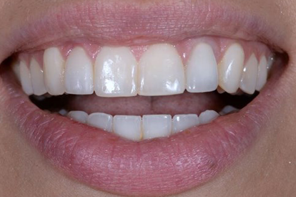 bone grafting