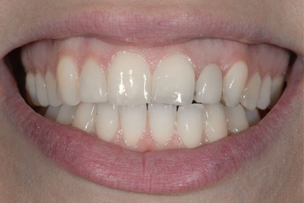 bone grafting