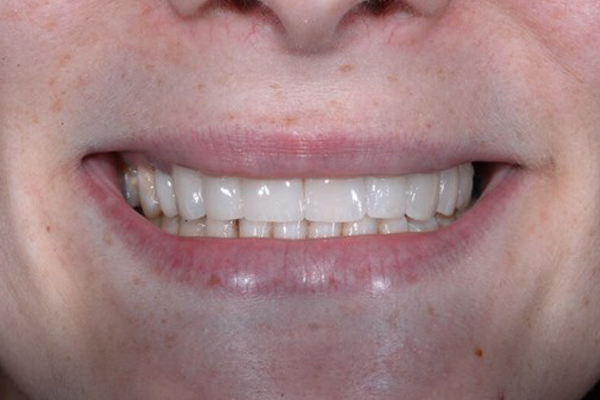 After Dental Crowns