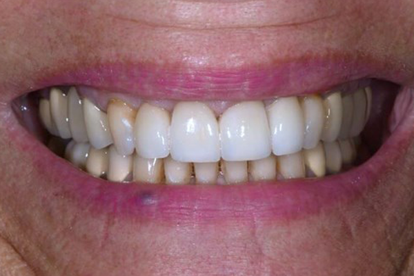 Dental Crowns