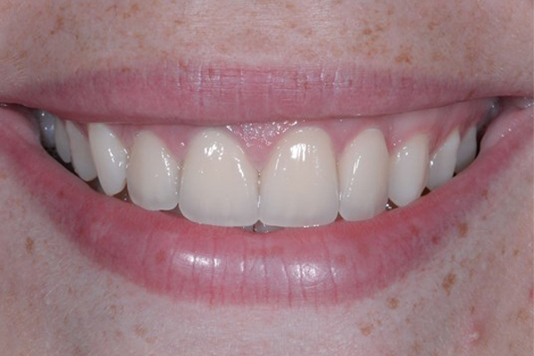 After Dental Crowns