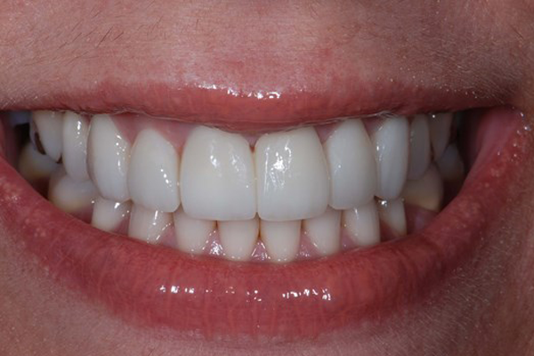 After Dental Crowns