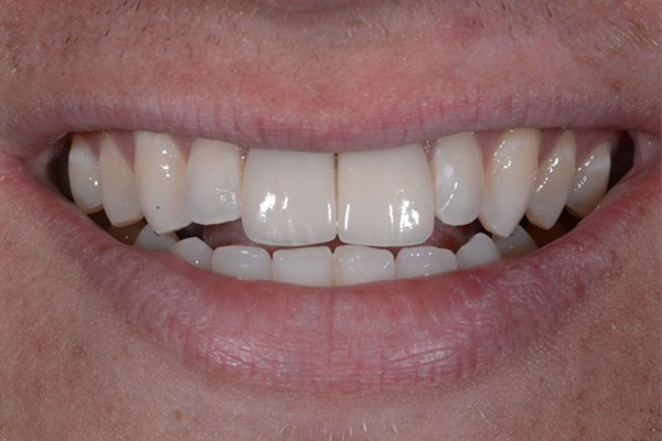 After Dental Crowns