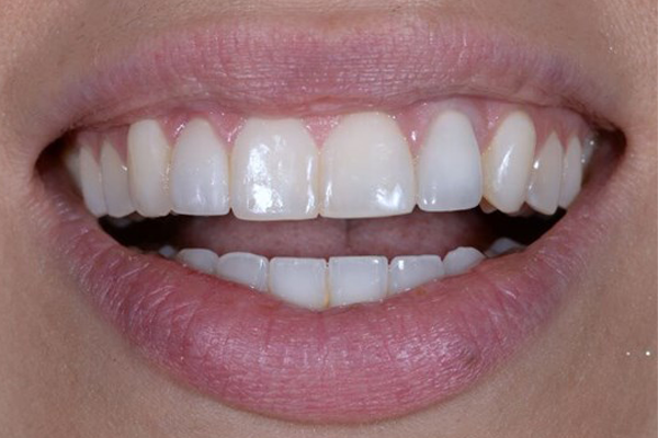 After Dental Crowns