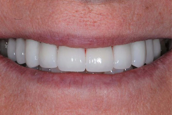 After Dental Crowns