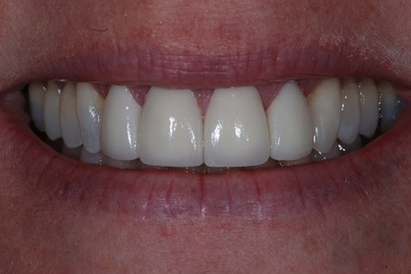 Before Dental Crowns