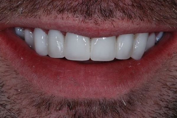 After Dental Crowns