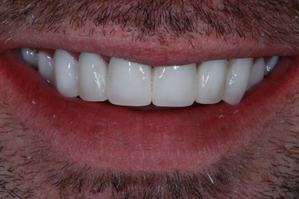 After Dental Crowns