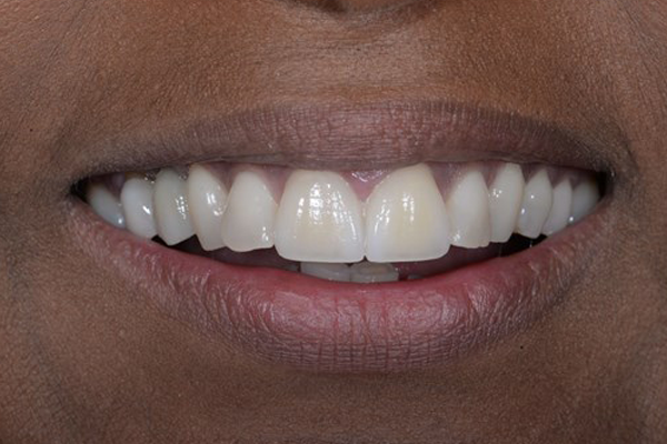 After Dental Crowns